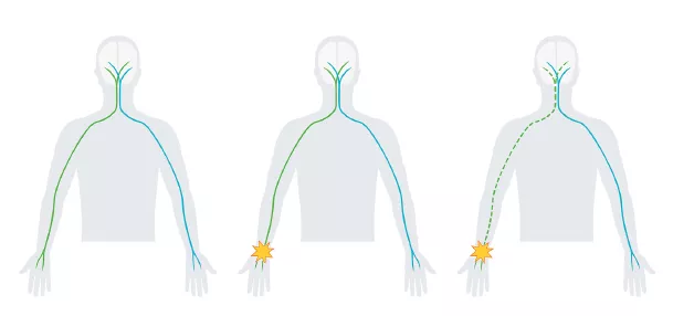 Diagram showing three upper body silhouettes with nerve paths.